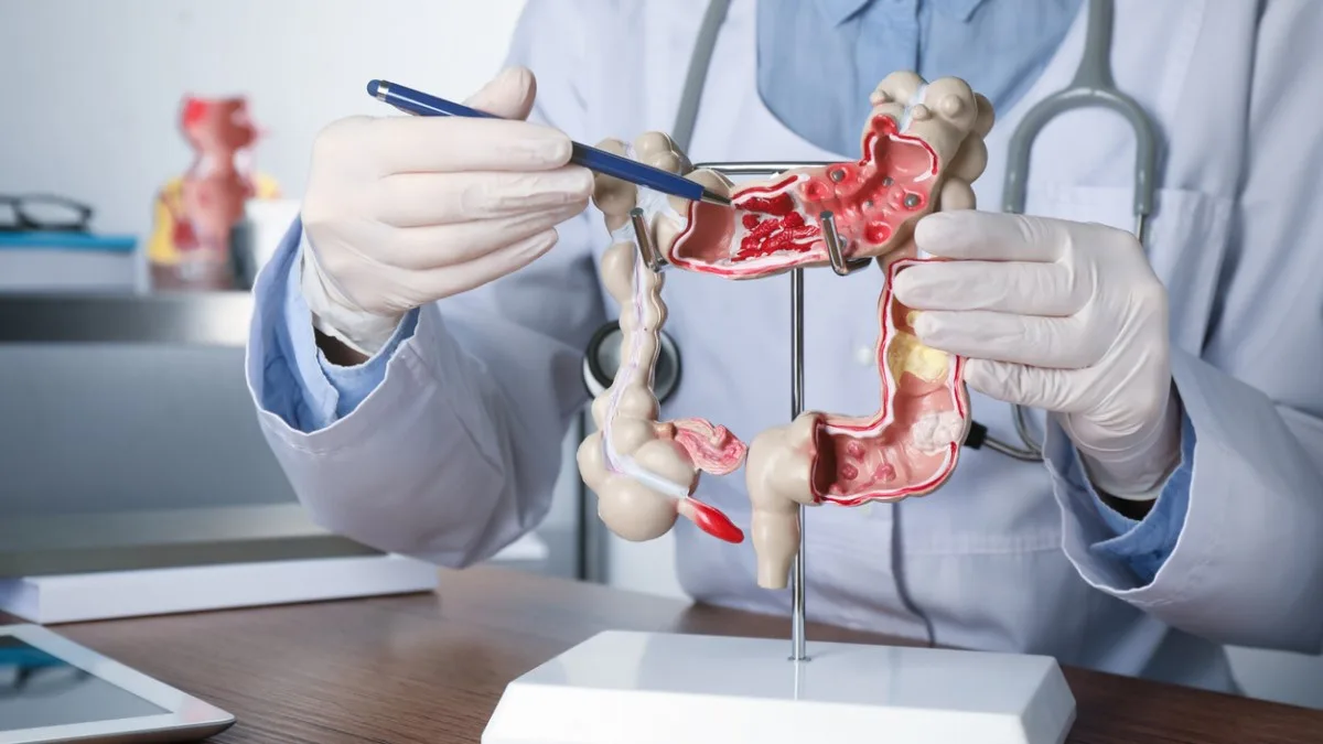 Las 5 conductas diarias que elevan el riesgo de cáncer colorrectal, según especialistas