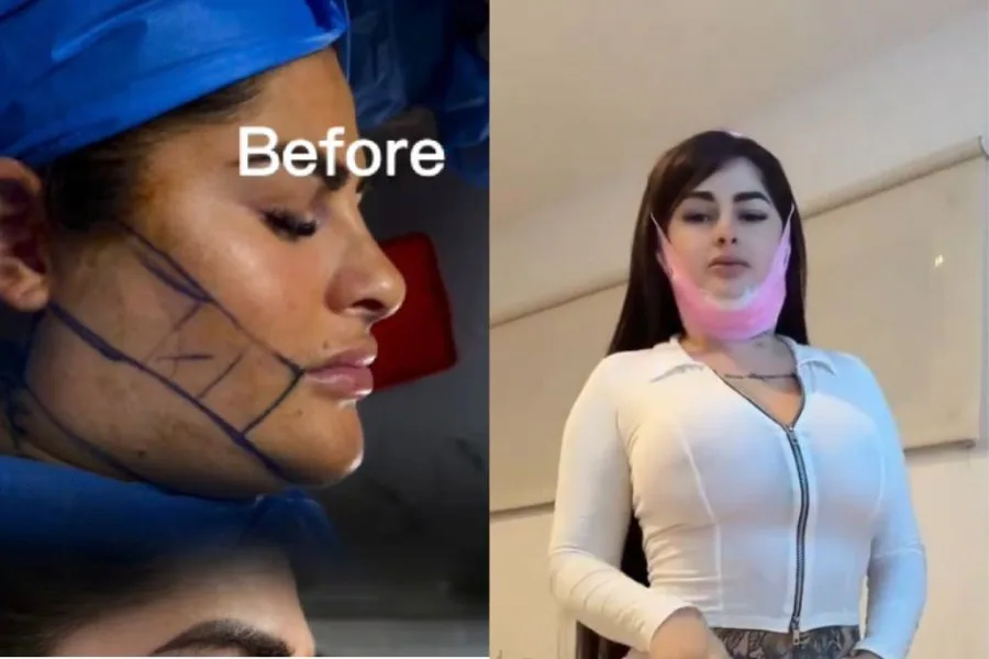 La influencer Kami Franco mostró el resultado de sus cirugías faciales y desató una fuerte polémica en redes
