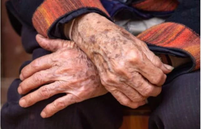 Tenía 87 años, murió en un geriátrico y la Justicia investiga por qué presentaba hematomas