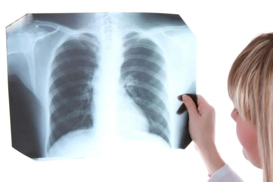 Preocupa el aumento de casos de tuberculosis en Argentina | Ya superaron los 17.000 de 2025