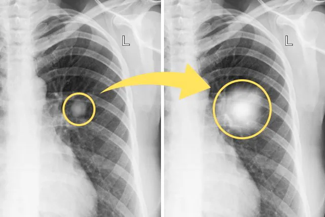 ¿Es grave un nódulo pulmonar? Las explicaciones médicas tras el anuncio del Papa
