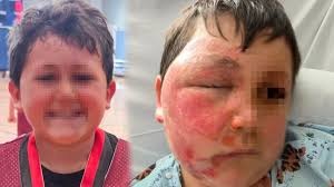 Reto viral terminó en tragedia: un niño sufrió graves quemaduras tras un desafío de TikTok