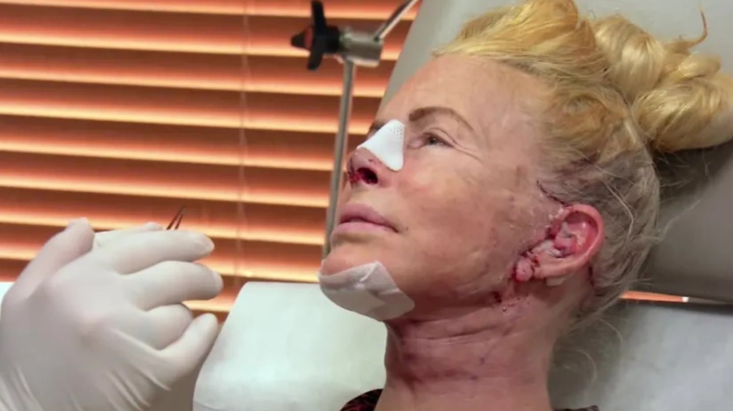 Se operó la nariz, no había anestesista y terminó de la peor manera