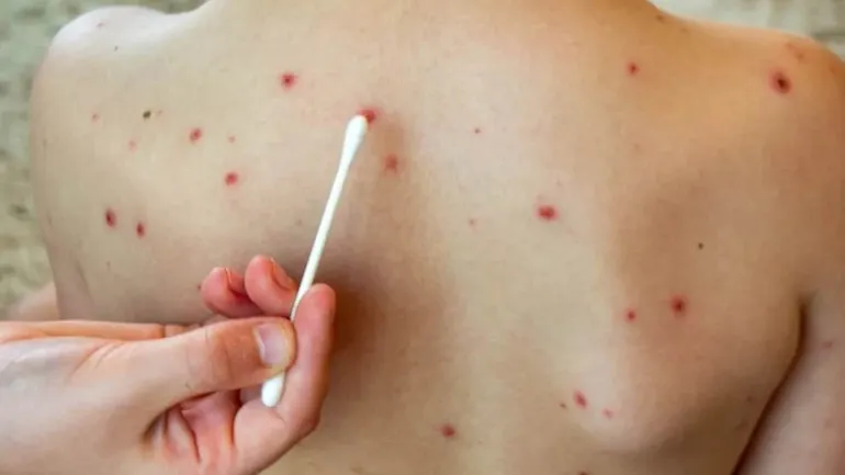 Sarampión en Argentina: activan bloqueos en tres jurisdicciones tras el primer caso importado