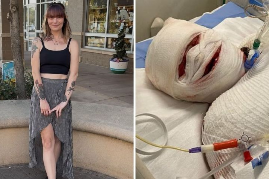 Reacción al ibuprofeno dejó a una madre de 27 años en coma y con el 95% de su piel desprendida