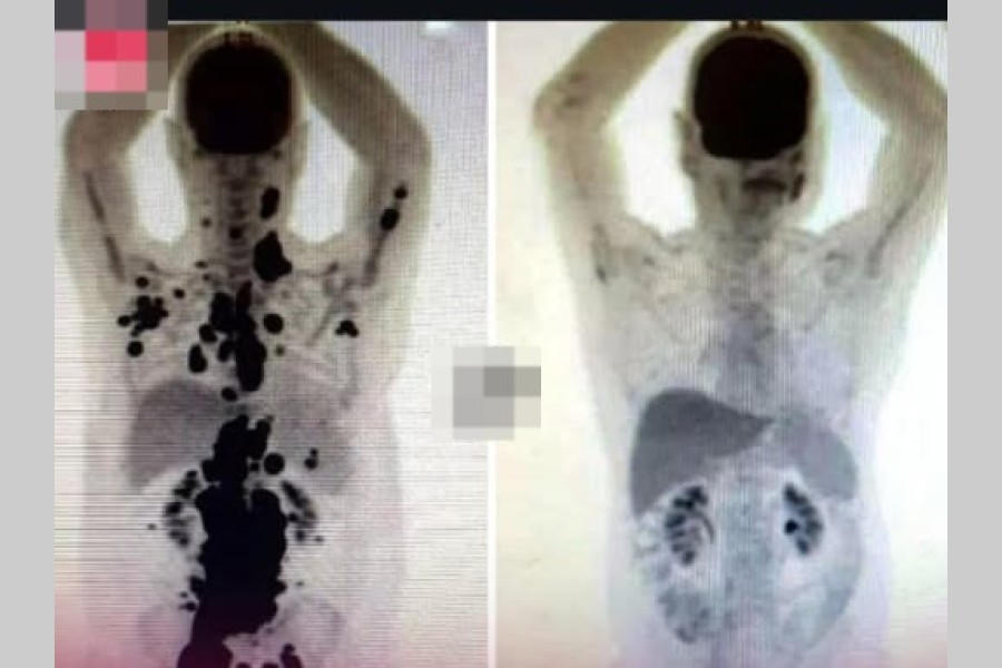 Le dijeron que ya no había opciones y un mes después ya no quedaban rastros del cáncer