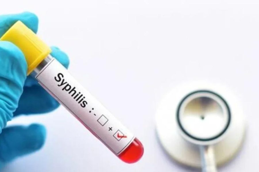 Argentina registró 46.799 casos de sífilis: su expansión entre jóvenes